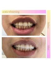 エクシアホワイトニング 西宮北口店/ホワイトニングビフォーアフター