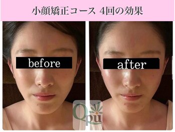 キュープ 表参道店(Qpu)/小顔矯正回コース4回の変化