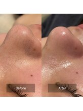 リュミエール デスポワール(lumiere d'espoir)/毛穴エクストラクション　洗浄