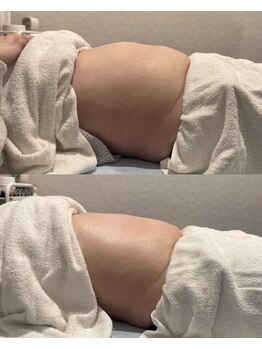 ビューティースタジオ ハンミ 新宿店(韓美)の写真/韓美オリジナルマシン『ヌベリス』で脂肪にダイレクトアプローチ！痛みやダウンタイムがありません♪