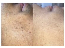 エルマナ(HERMANA)/メンズ脱毛/ヒゲ脱毛/VIO脱毛