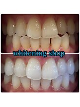 ホワイトニングショップ 阪急伊丹店/お客様のビフォーアフター