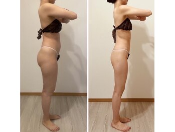 プリマ(prima)/ダイエット症例