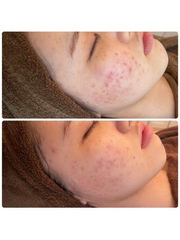 エピシア(Epicia)/ハーブは肌荒れ改善にも◎