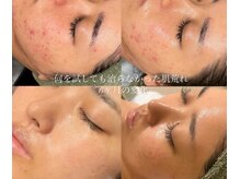 オーシャンブルーム 目黒(OceanBloom)/乾燥ニキビ