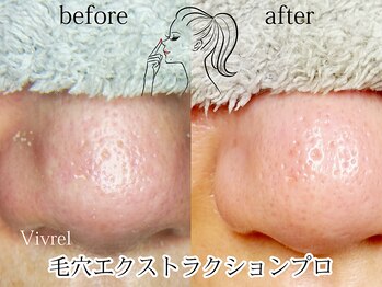 ヴィヴレル(Vivrel)/【毛穴エクストラクションプロ】