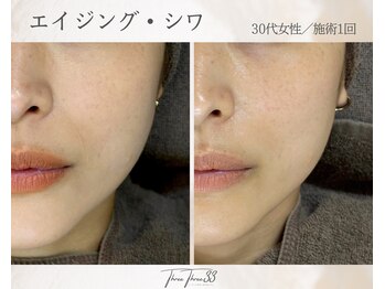 スリースリー(THREE THREE)/エイジング・しわケア