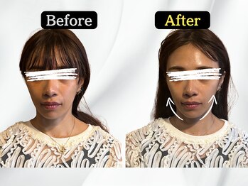 ハリユナイテッド 原宿鍼灸 整体院(HALI UNITED)/フェイスラインスッキリ!