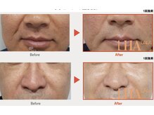 ピオラ(Piora)の雰囲気（ララピールで艶玉水光肌へ♪お肌を育てる優しいピーリング◎）