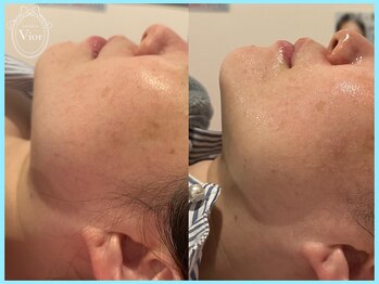 ヴィオール 名古屋栄店(VIOR)/光Vショットと併用でEライン激変