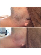サロン 半田店(SALON)/大人気ヒゲ脱毛☆