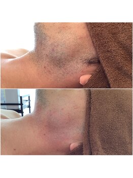 サロン 半田店(SALON)/大人気ヒゲ脱毛☆