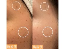 ニコ(nico)の雰囲気(美容液使用2ヶ月。シミ・毛穴・くすみ等肌の奥から働きかける!)