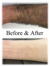 シャイニー/腕脱毛１８回