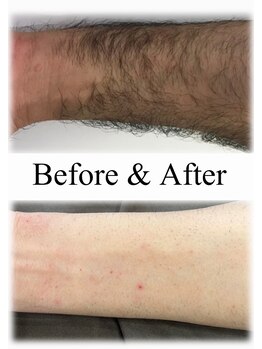 シャイニー/腕脱毛18回