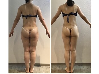 カリス/全身10回ビフォーアフター