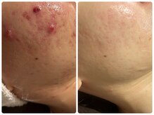 ブリリアント(Brilliant)/ニキビケアにはハーブピーリング