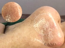 キャンディ 難波心斎橋店(CANDi)/ハイドラピーリング/黒ずみ毛穴