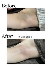 リネ(Rine)/before→after