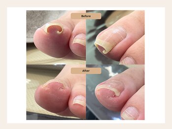 ルポ 伊勢/巻き爪ケア