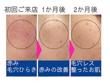 【本気の肌質改善】西新宿フェイシャルエステBelle≪ベル≫乾燥|赤み|毛穴|くすみの雰囲気(お肌のお悩みをケアしながら解決に向けて徹底サポート!)