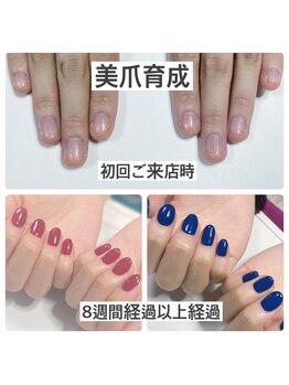 マニュコクーン(ManuCocoon)/爪育成 深爪 巻き爪 大阪市