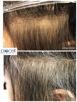 ヒルナム(Heal Nam)/プロセルセラピーズ~頭皮~