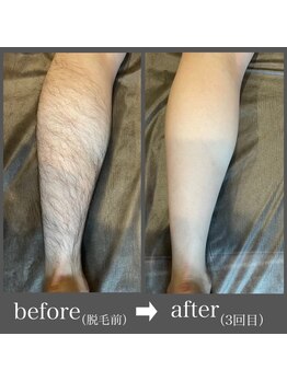 ブルーグロウ(Blue Glow)/足脱毛ビフォーアフター