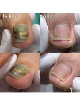 巻き爪補正店 札幌店/ 【分厚い爪/変形爪再生補正】