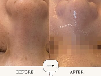 ハイフン(HIFUN)/毛穴洗浄×引き締め