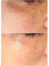 ジン フォー ユアビューティー(JIN for your beauty)/施術経過