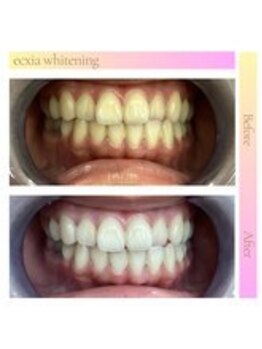 エクシアホワイトニング 西宮北口店/ホワイトニングビフォーアフター