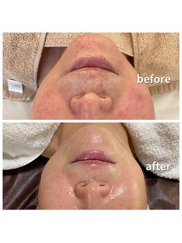 サロン グリッター 新宿(Salon GLITTER)/【肌質改善】ビフォーアフター