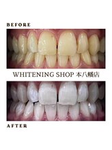ホワイトニングショップ 本八幡店/BeforeAfter ホワイトニング