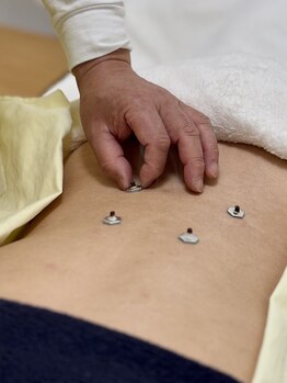 番町もくの木鍼灸院/灸　腰部施術