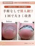 【歩くと痛い巻き爪に◎切らない矯正】 ¥15400~ (¥6600＋装具代￥8800)90分