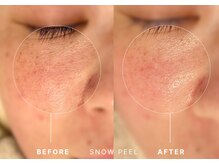 シュリー(Sriii)/ワイコ水光ピールでハリUP♪