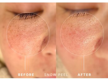 シュリー(Sriii)/ワイコ水光ピールでハリUP♪