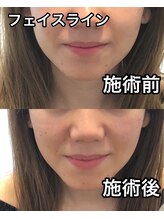 プレシャスワン 越谷店/美容鍼もダイエットも維持継続！