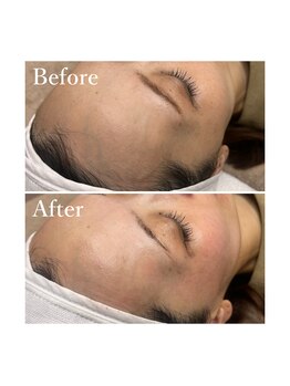 ホワイトワックス 京都四条烏丸(WHITE WAX)/全顔フェイシャルワックス