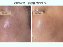 グロウ バイ フェイシャルデザイン アンド アイ(GROW)の雰囲気（お肌内部からの根本改善できるのはGROWだけ♪持続性も◎）