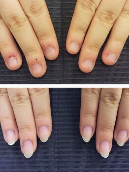 レガート(Legato)の写真/深爪・噛み爪・巻爪は、プロの丁寧なケアにおまかせ◎【爪育成】で、見せたくなるほど自信が持てる指先へ♪
