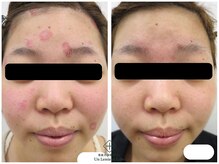 アンレミューラボ(Un Lemieux Labo)/かぶれ改善