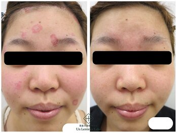 アンレミューラボ(Un Lemieux Labo)/かぶれ改善