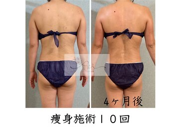 アイ エステサロン(Ai)/【40代】痩身・背中のお肉☆