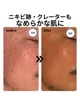 マヴィ(Ma vie)/ニキビ・凹凸改善