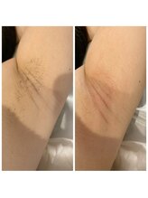 パームスエル(palms.L)/《脇脱毛》