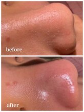 プラム(plum)/その毛穴、諦めていませんか？