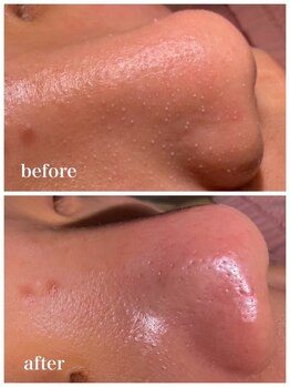 プラム(plum)/その毛穴、諦めていませんか？