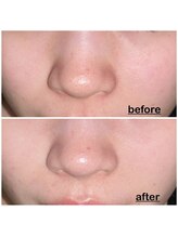 ミニョン(mignon)/お鼻の黒ずみ気になりませんか？